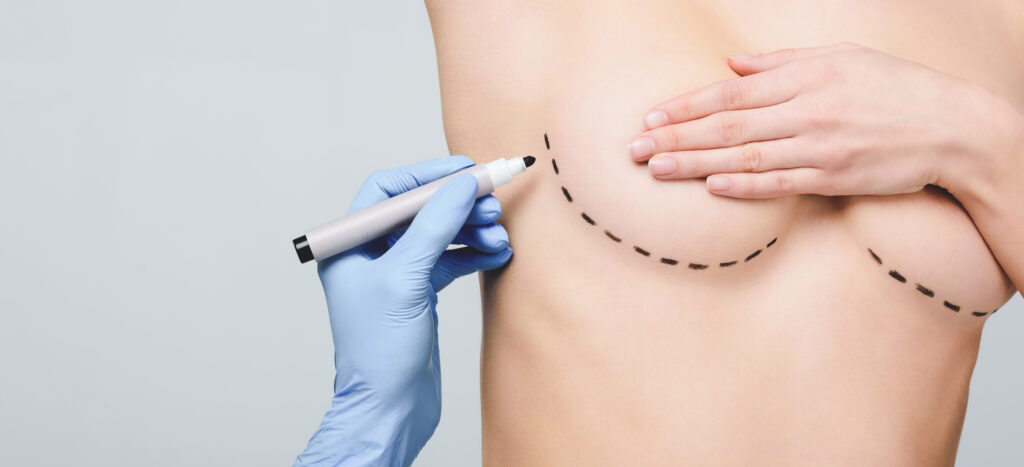 Plastic surgeon marking lines under breast