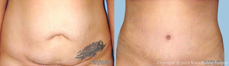 Tummy Tuck Photos
