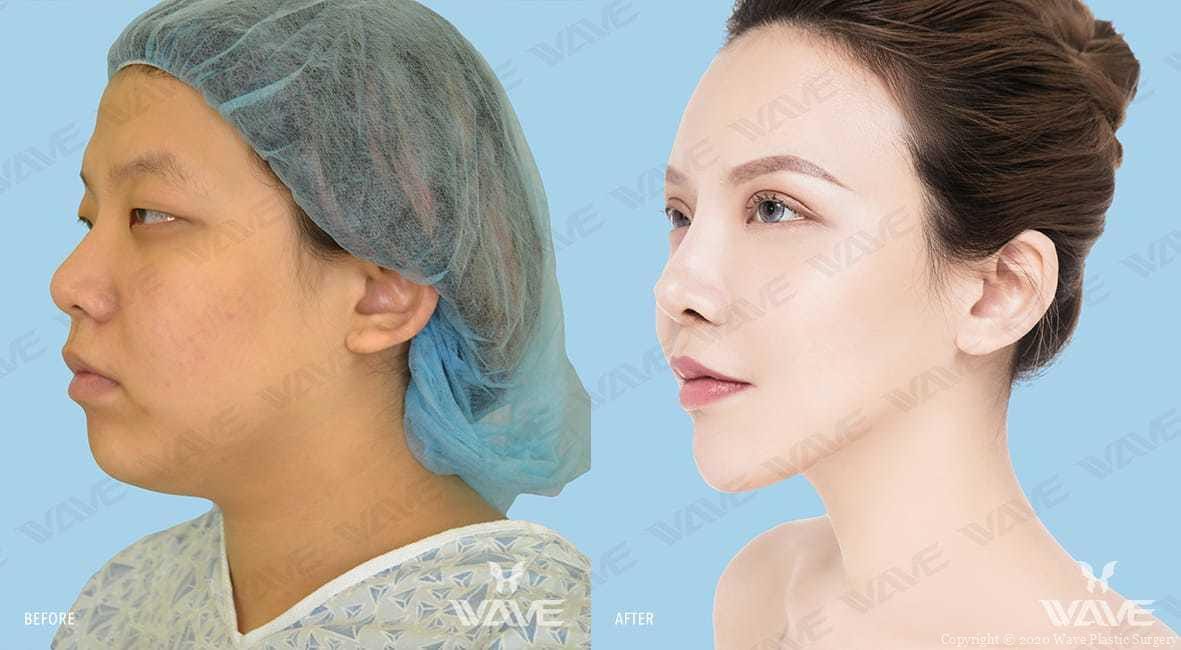 Before and after photo at Wave Plastic Surgery