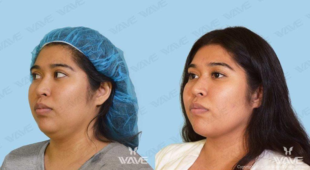 Restylane Lyft fillers for nose and chin