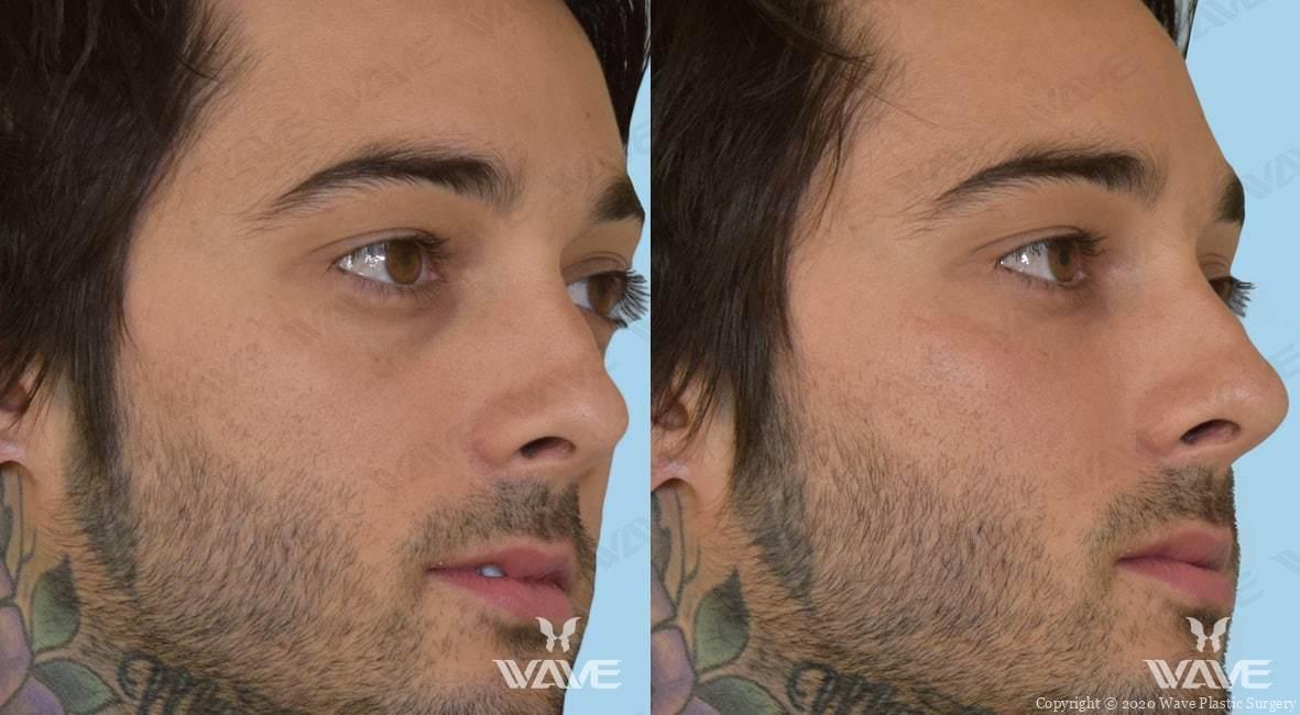 Patient above received Volbella to his tear troughs.