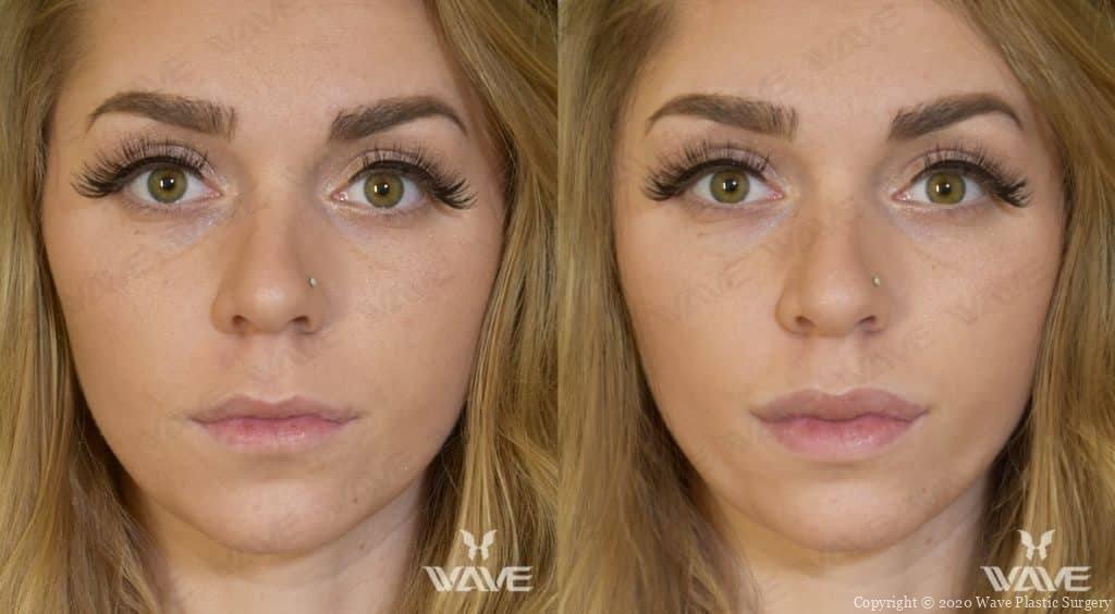 Patient above received Juvederm to her lips.