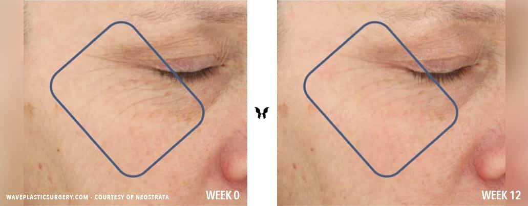 Wave World Exclusive: Add Volume To Your Face Without an Injection! 63d Tri Therapy Volumizes BA
