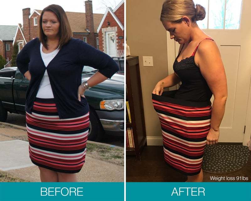 Take Control of Your Overeating - Get $1,500 OFF Obalon!* 65e Lisa BA weightloss
