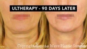 Ultherapy Before and After 90 days
