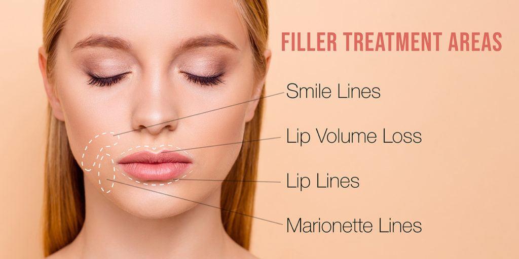 Allergan Filler Treatment diagram