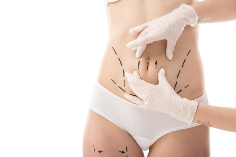 Partial view of plastic surgeon in latex gloves and patient in underwear with liposuction marks on body isolated