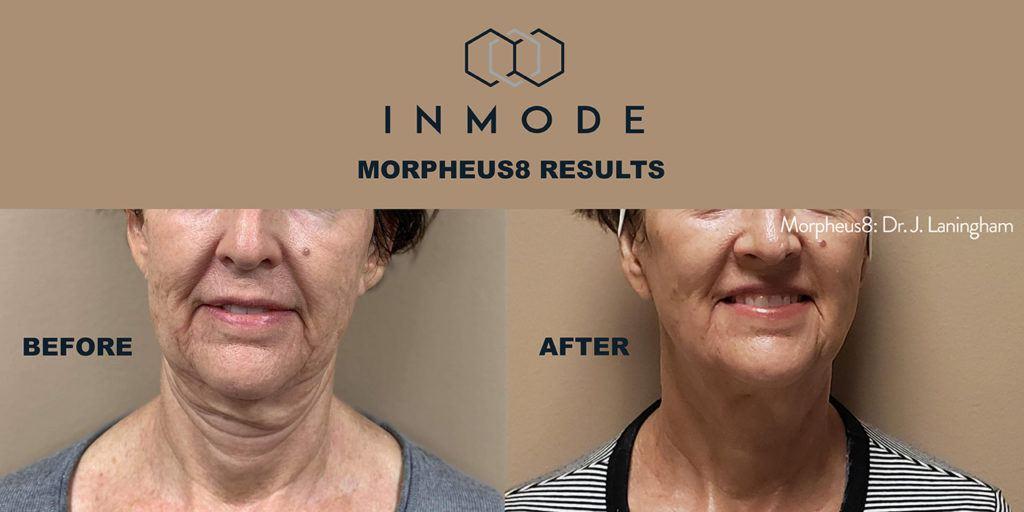 Inmode Morpheus8 results