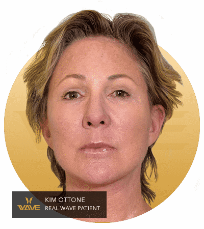 Kim Ottone - A Wave patients testimonial image