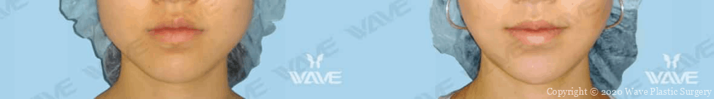 Before & After images of Jaw Surgery