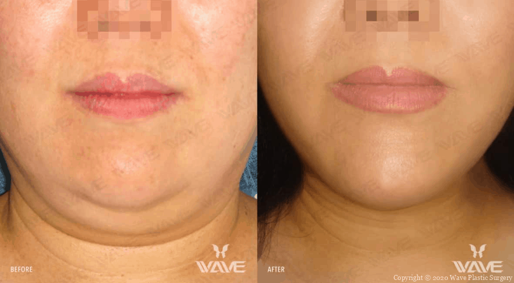 Precision Lift Before and After photos at Wave Plastic Surgery