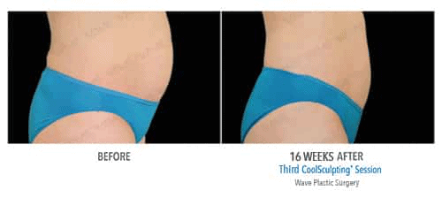 Coolsculpting Before and After Image