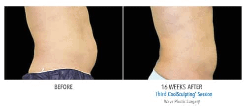 Coolsculpting Before and After Image
