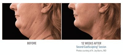 Cool Mini Coolsculpting Before and After Image