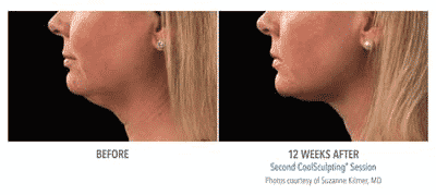Cool Mini Coolsculpting Before and After Image