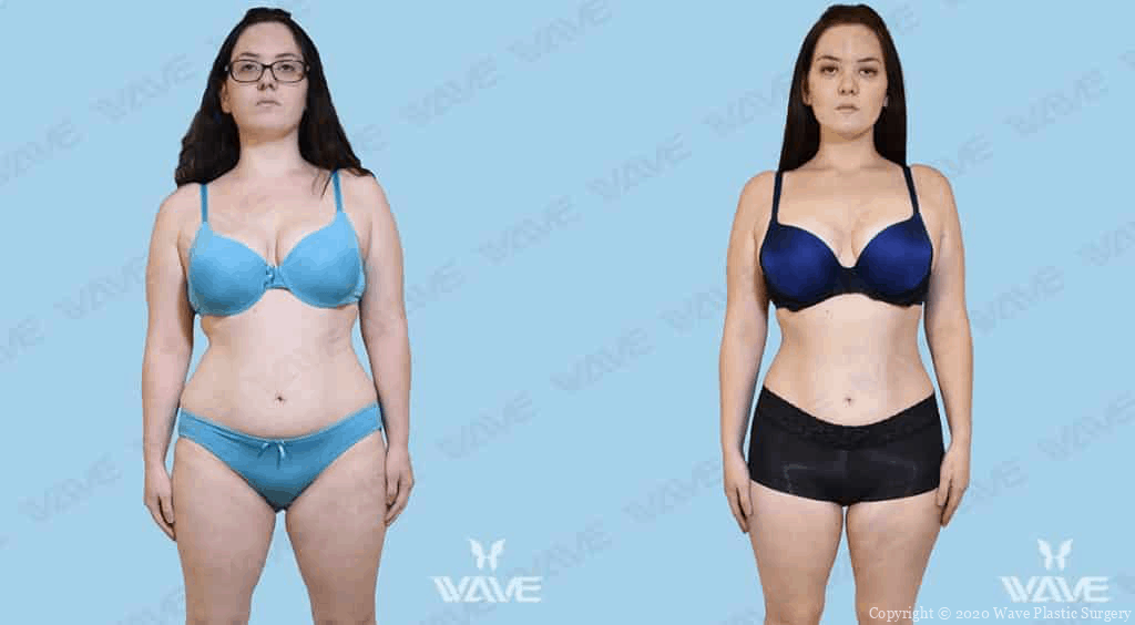 Mediessence before and after photo