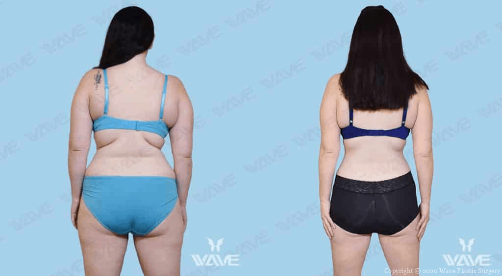 Mediessence before and after photo