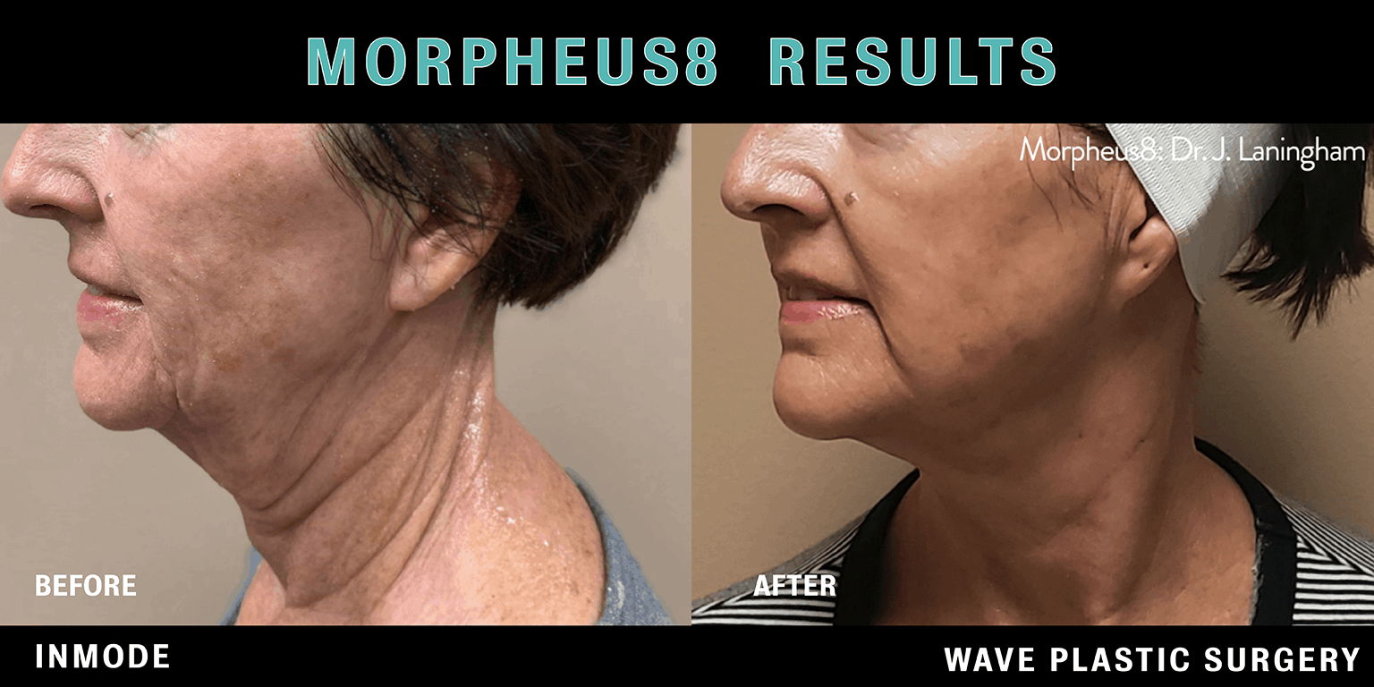Morpheus8 Before and after photos
