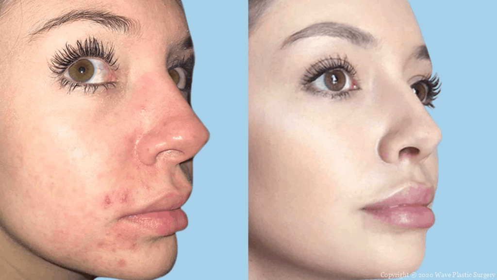 Before and after Scarlet RF photos