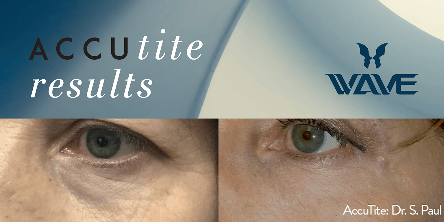 Accutite Results before and after photo