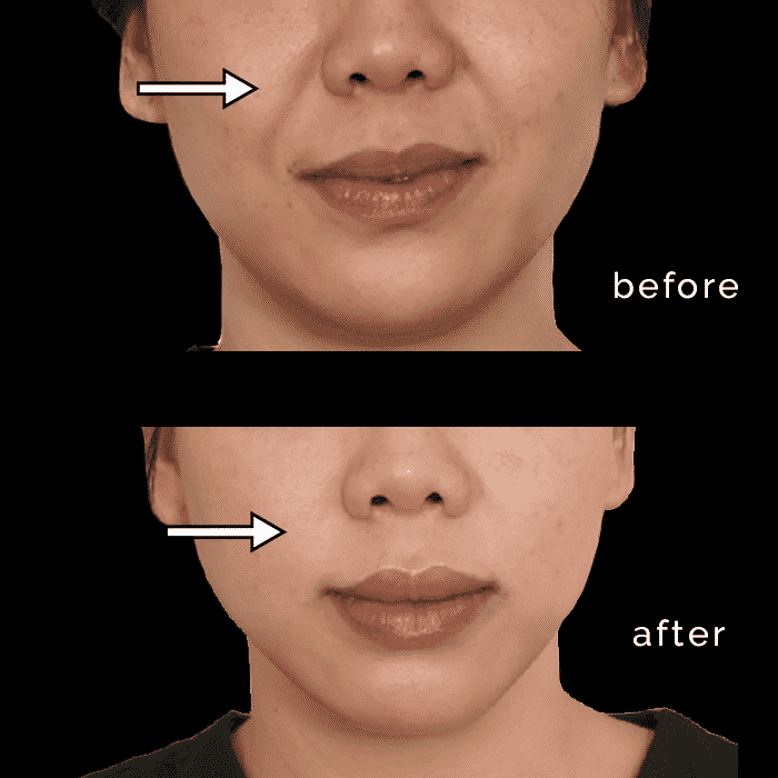 Restlyne Lyft Before and after images