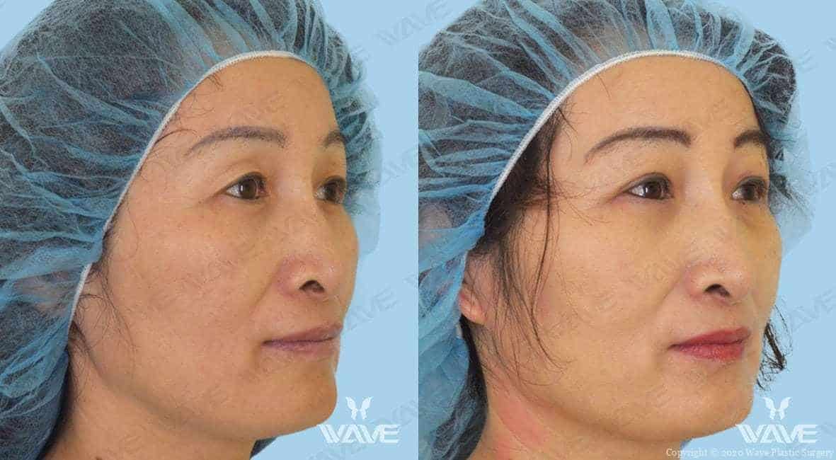 Before and After Face Procedures | Wave Plastic Surgery