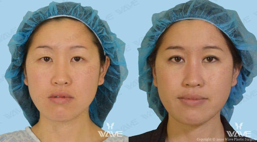 Asian Blepharoplasty Photograph Female