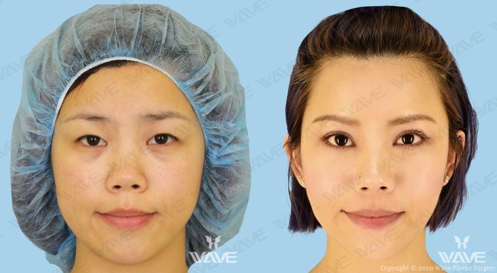 Asian Blepharoplasty Photograph Female