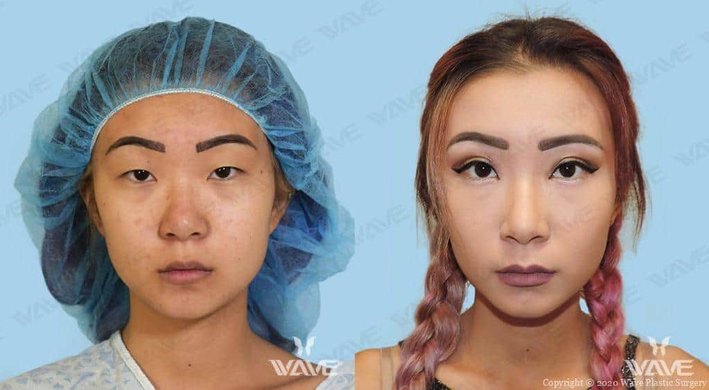 Asian Blepharoplasty Photograph Female