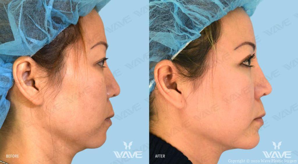 Chin Augmentation Before and After Female Photography