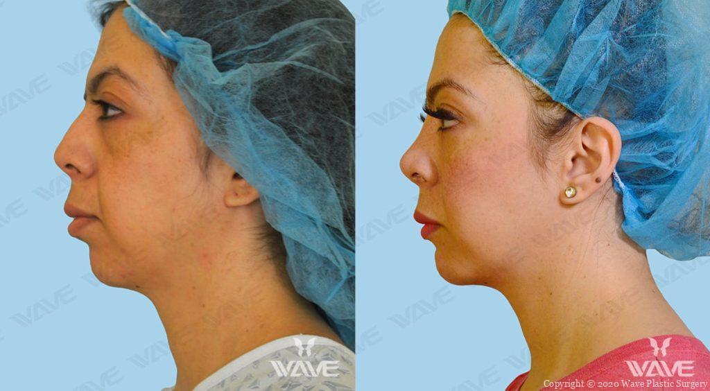 Chin Augmentation Before and After Female Photography