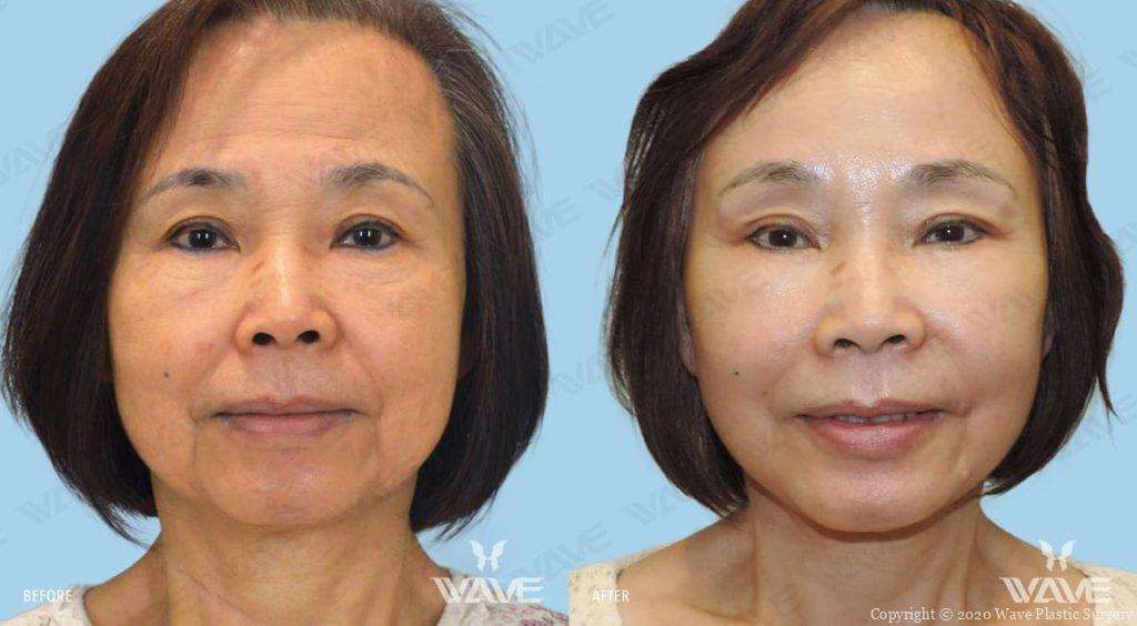 Endoscopic brow lift before and after photgraph