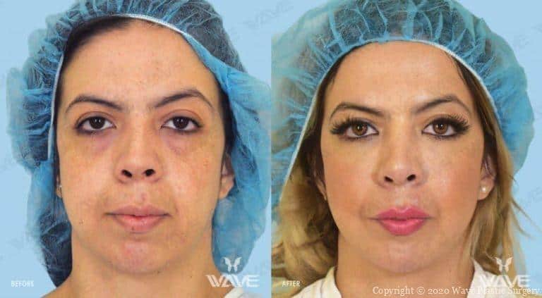 Endoscopic Mid Face Lift Before and After Photo