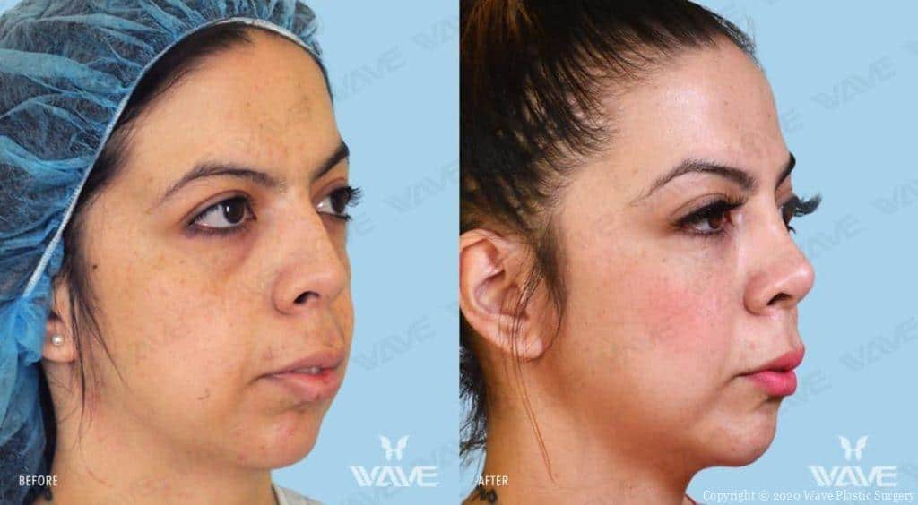 Endoscopic Mid Face Lift Before and After Photo