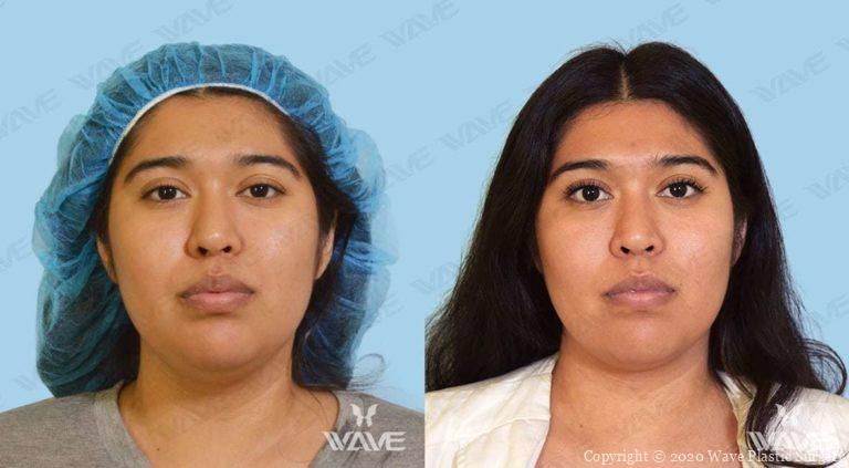Kybella Before and After Photo