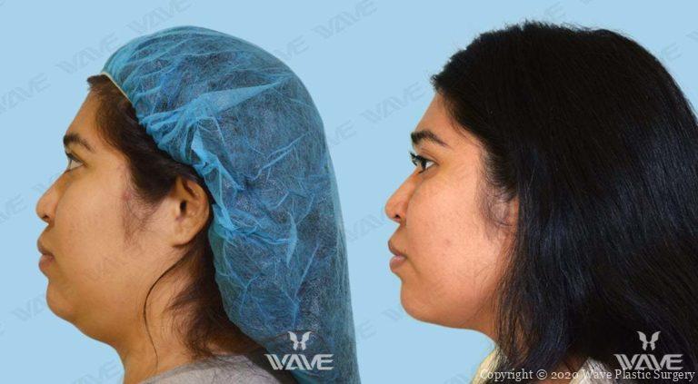 Kybella Before and After Photo