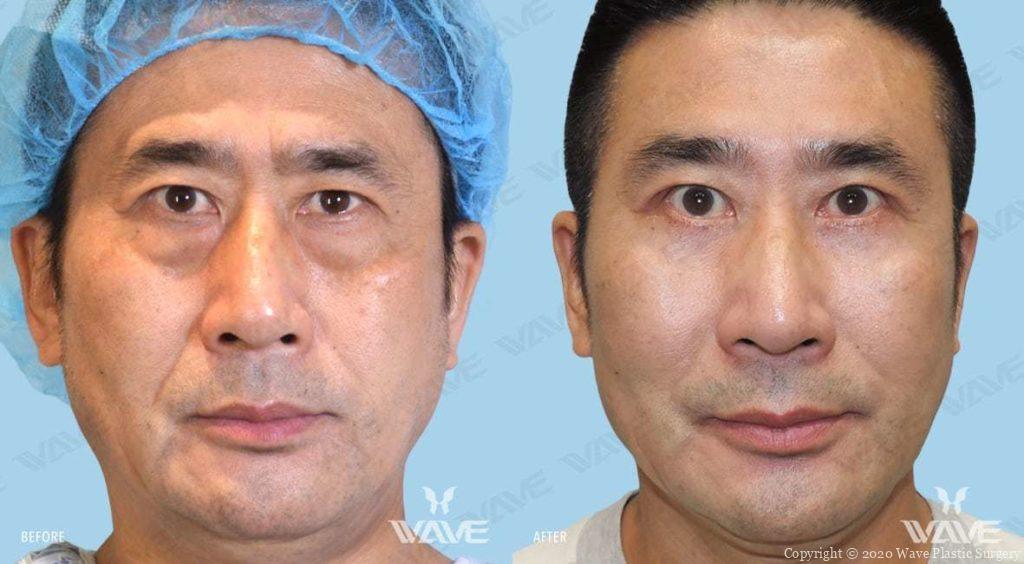 Lower Blepharoplasty before and after photograph