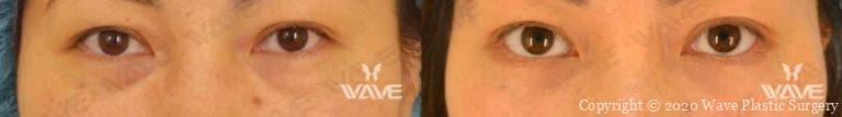 Lower Blepharoplasty before and after photograph