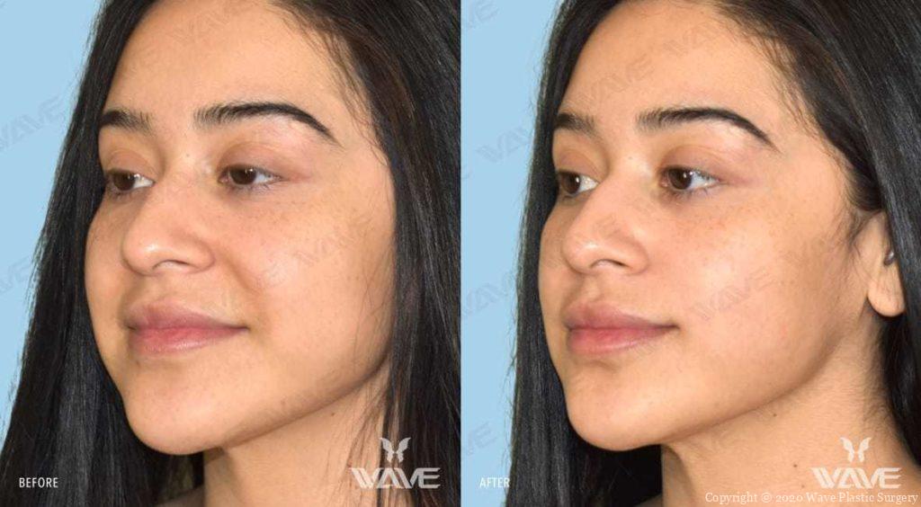 Dermal Fillers restylane 02b
