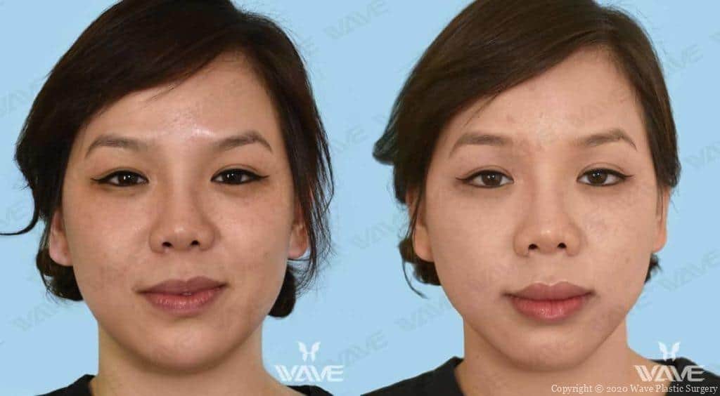 Dermal Fillers restylane 04b