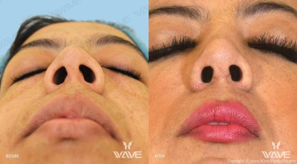 Rhinoplasty in Los Angeles | Wave Plastic Surgery