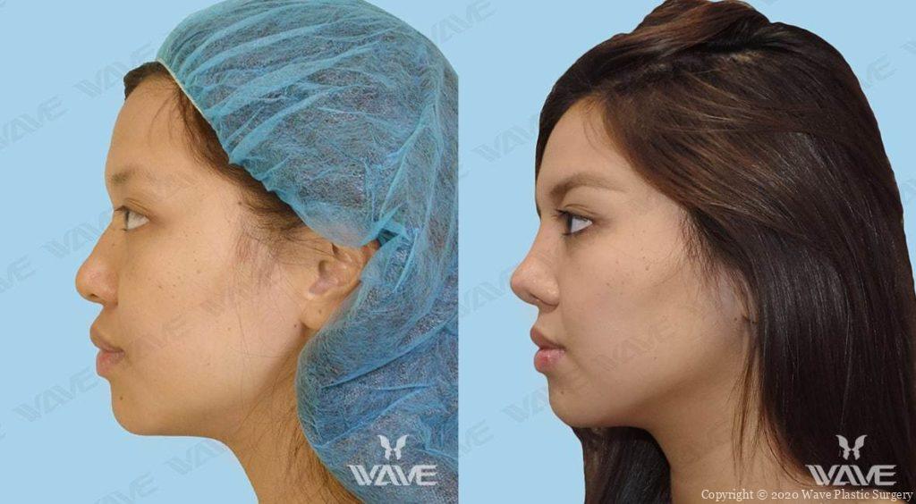 Rhinoplasty before and after photo