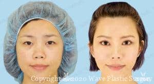 asian double eyelid before and after