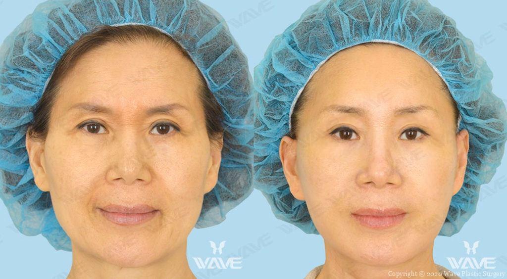 endoscopic brow lift-before and after