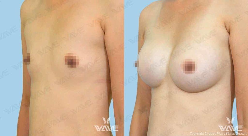 Breast Augmentation Photo before and after