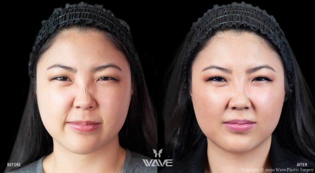Neuromodulators Minji Lee Botox 1181x650 web template