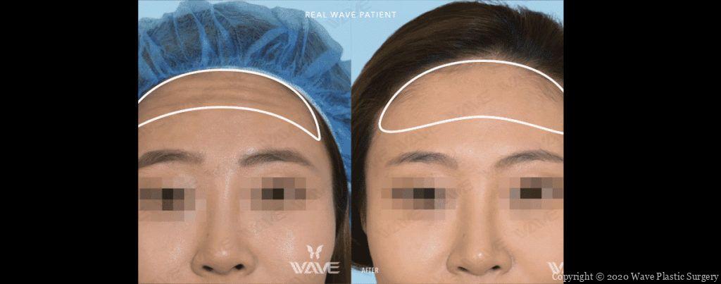 Baefore After Prevent Forhead Wrinkles Wave Blog Banner