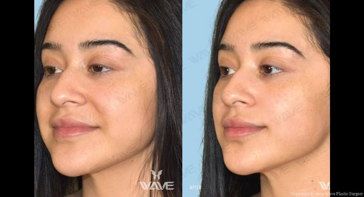 Lizbeth Gets Rid Of Her Smile Lines Wave Plastic Surgery