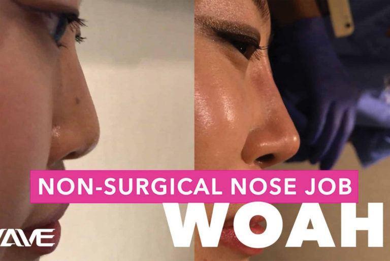 Non Surgical Nose Job Blog Post Image