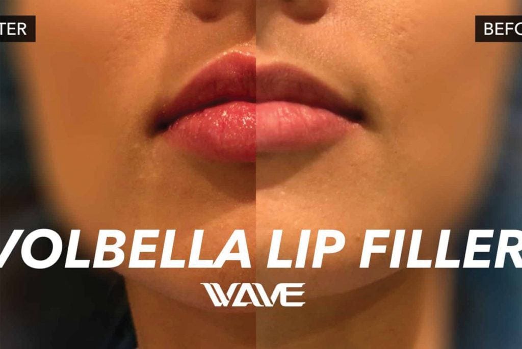 Volbella Lip Filler Blog post Image